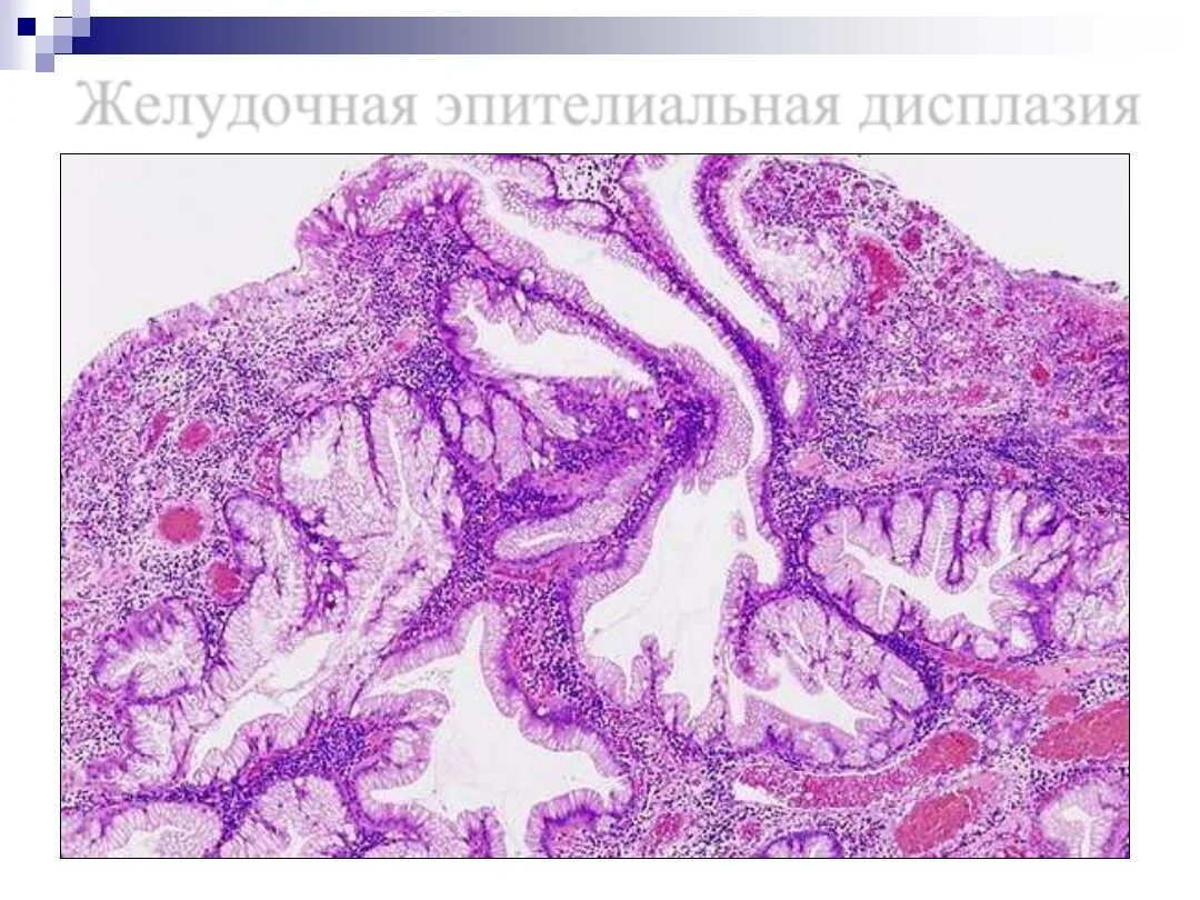 Микровезикулярный полип толстой кишки. Гиперпластический полип желудка гистология. Полип толстой кишки гистология. Гиперпластический полип толстой кишки гистология. Полип желудка гистология.