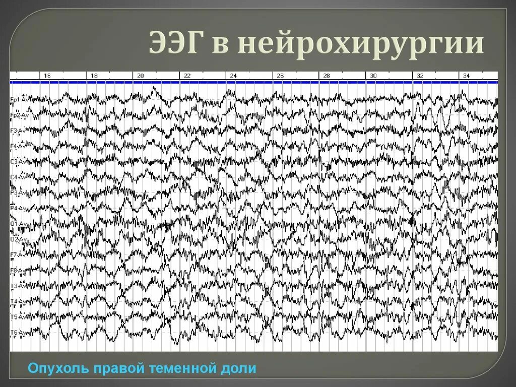 Ээг оренбург. Электроэнцефалография (ЭЭГ) метод исследования. ЭЭГ В психиатрии. Электроэнцефалография головного мозга (ЭЭГ). ЭЭГ при опухоли головного мозга.