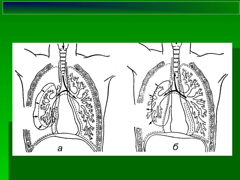 Тип одышки при пневмотораксе. Пневмоторакс истории. Пневмоторакс истории. Пневмоторакс истории. Пневмоторакс физиология.