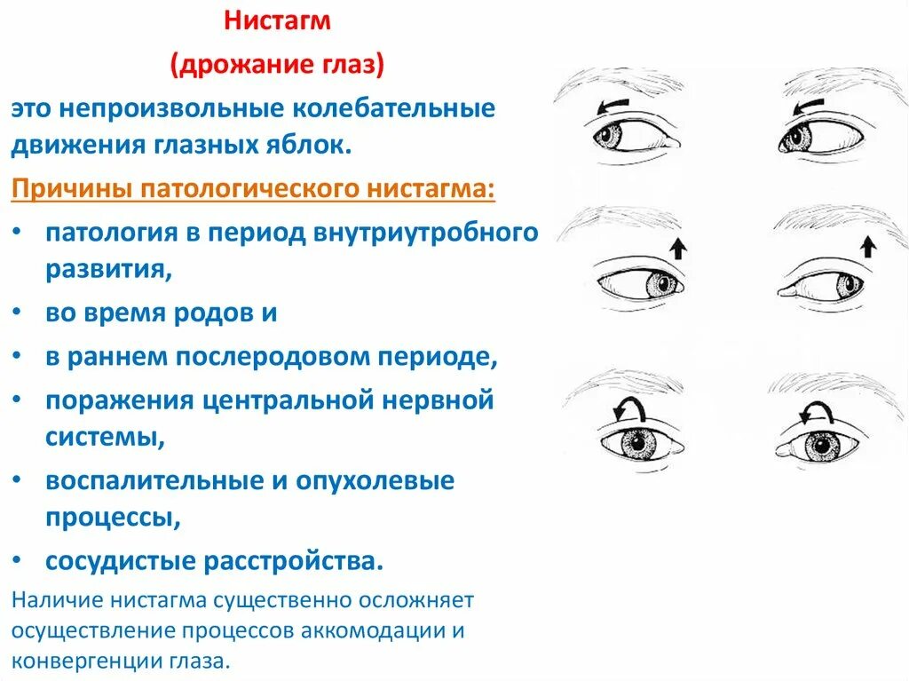 Ощущение мелкого. Ротаторный нистагм причины. Горизонтальный ротаторный нистагм. Горизонтальный нистагм причины. Горизонтальный нистагм в норме.