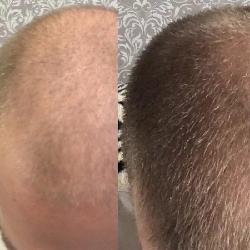 Миноксидил 5 ℅. Minoxidil kirkland миноксидил 5% 60 мл. Миноксидил для волос головы отзывы. Миноксидил для волос головы отзывы. Миноксидил для волос головы отзывы.