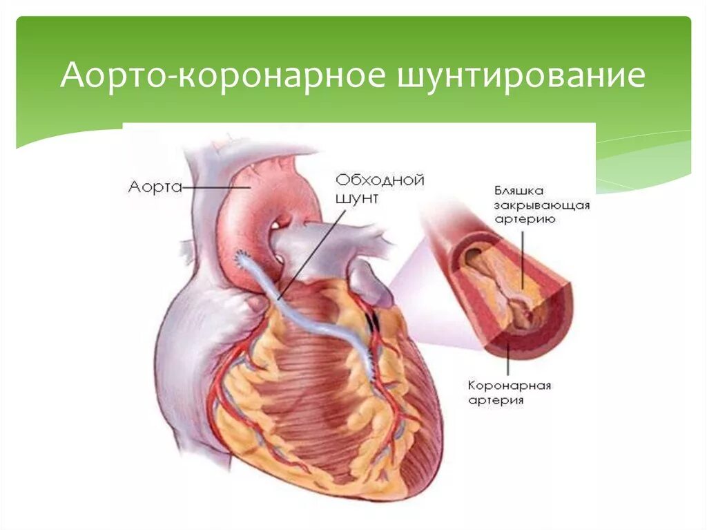 Операции коронарных артерий. Коронарное шунтирование сосудов. Аутовенозное аортокоронарное шунтирование. Аорта....аортокоронарное...шунтирование. Аорта коронарное шунтирование.