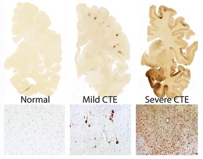 Cte