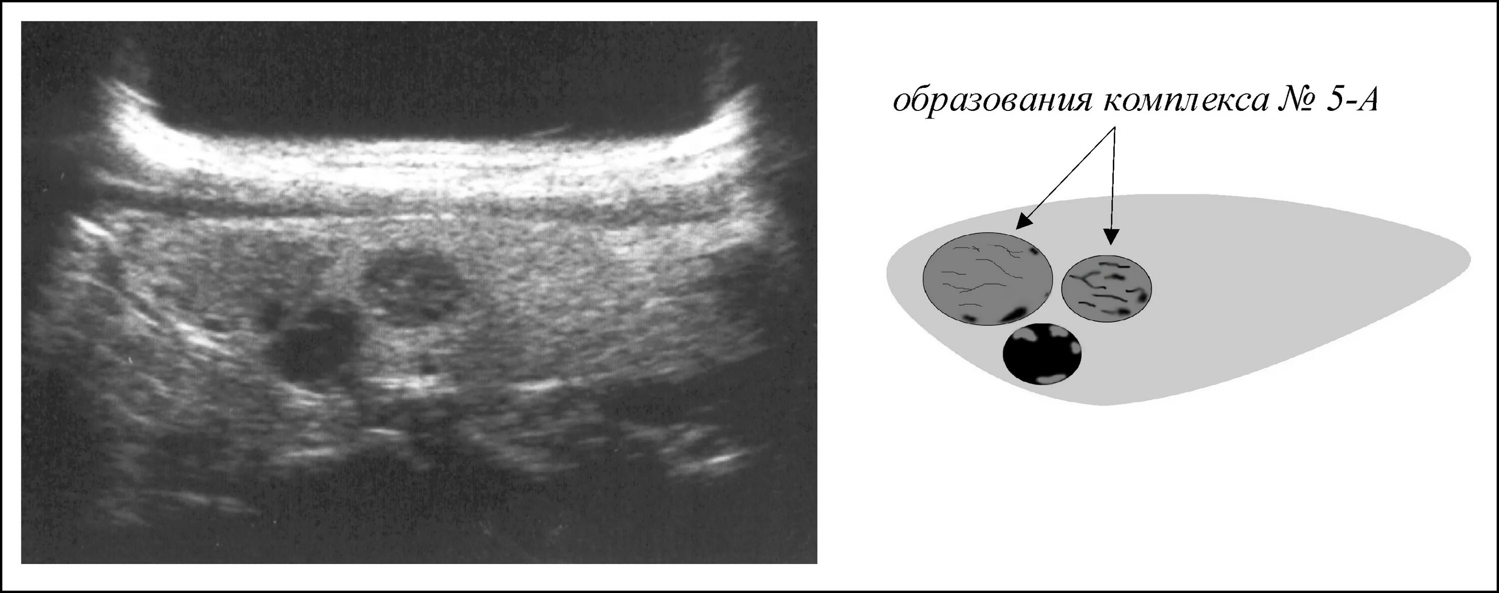 Кальцинат в правой доле. Гипоэхогенное образование УЗИ. Гипоэхогенные образования в печени по УЗИ. Гиперэхогенные кисты яичника. Гипоэхогенное образование в яичнике что это такое на УЗИ.