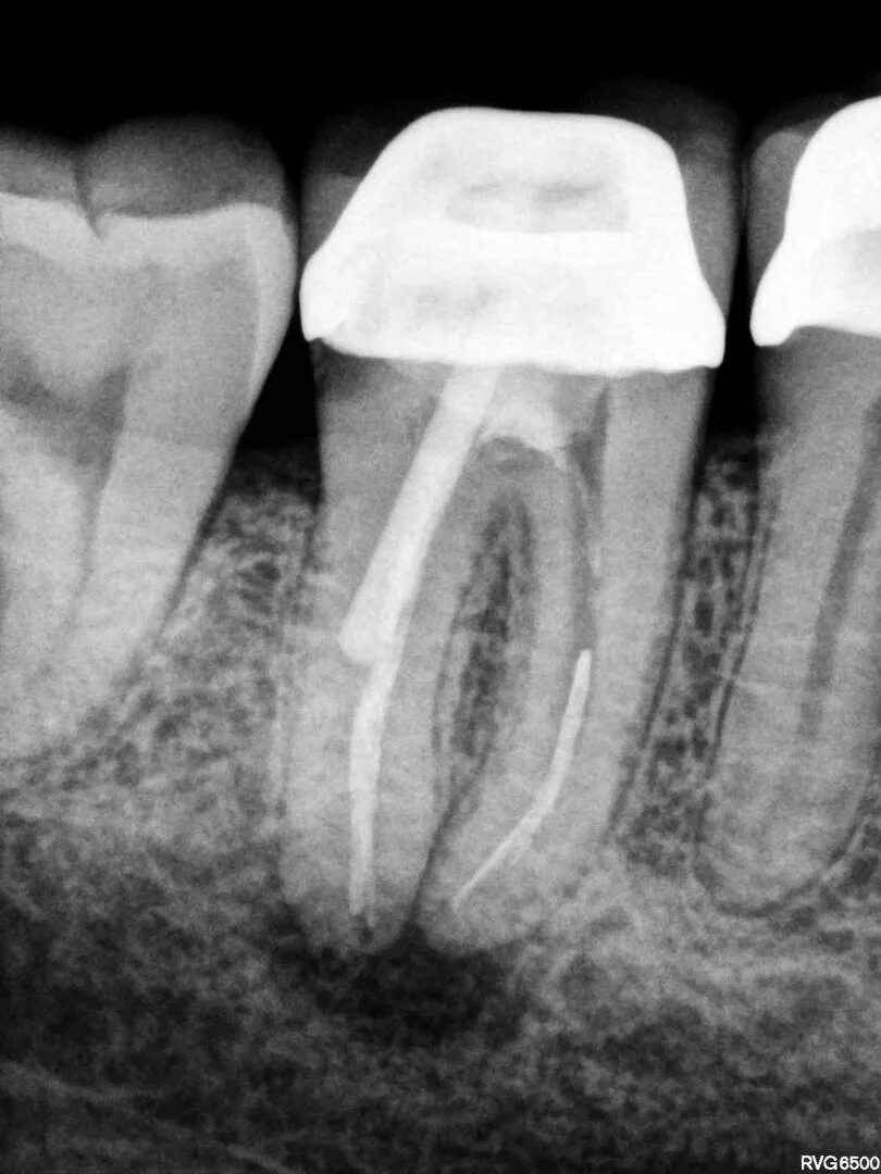 Воспаление канала зуба. Гранулематозный периодонтит рентген зуба. Гранулематозный апикальный периодонтит. Хронический гранулематозный апикальный периодонтит. Острый апикальный периодонтит.