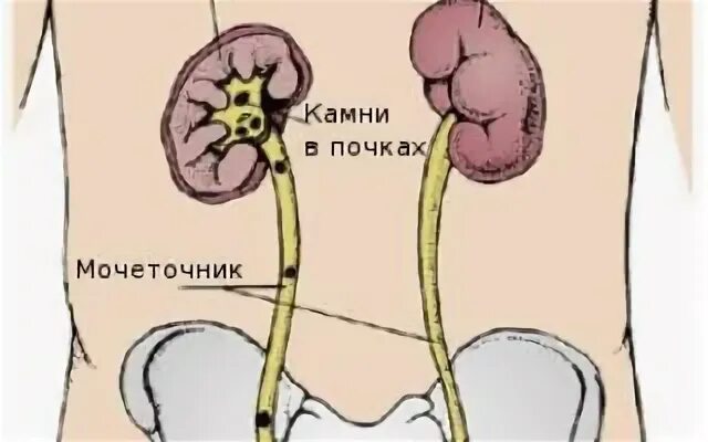 Стенд в мочеточнике при камнях в почках. Камень в мочеточнике у мужчин. Нижняя треть мочеточника у мужчин.