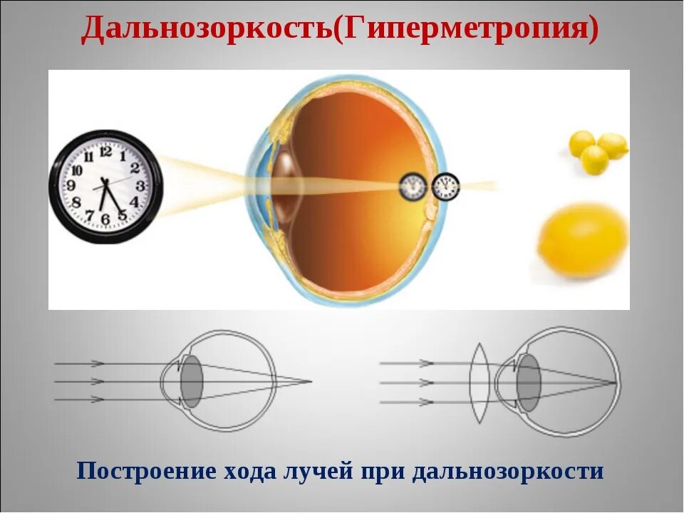 Операция при дальнозоркости. Ход лучей при близорукости и дальнозоркости. Линзы для дальнозоркости. Дальнозоркость ход лучей. Дальнозоркость схема глаза.