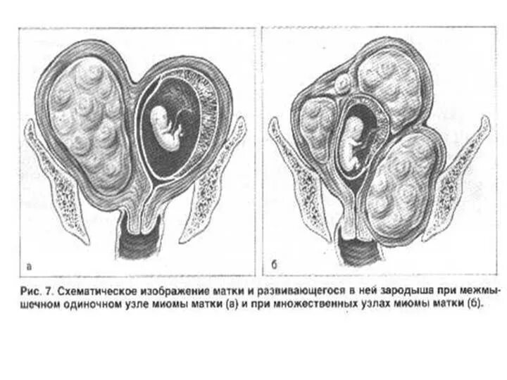 Плотная шейка. Двурогая матка с перегородкой. Миоматозный узел при беременности. Двурогая матка с полной перегородкой.