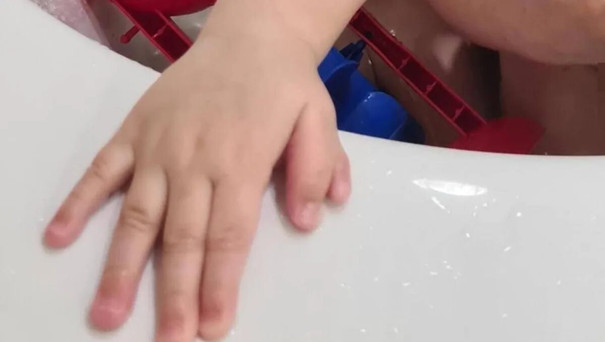 6 пальцев на руках у детей. Дети с шестью пальцами.
