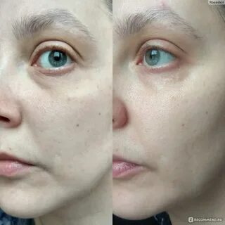 Кислота для лица отзывы