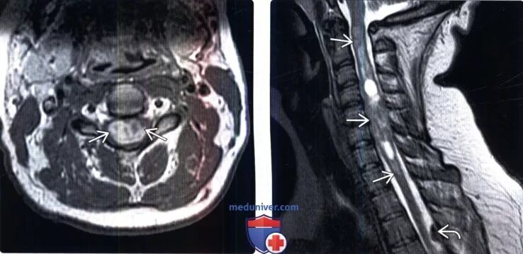 Эпендимома спинного. Эпендимома мрт позвоночника. Эпендимома спинного мозга. Эпендимома поясничного отдела позвоночника мрт.