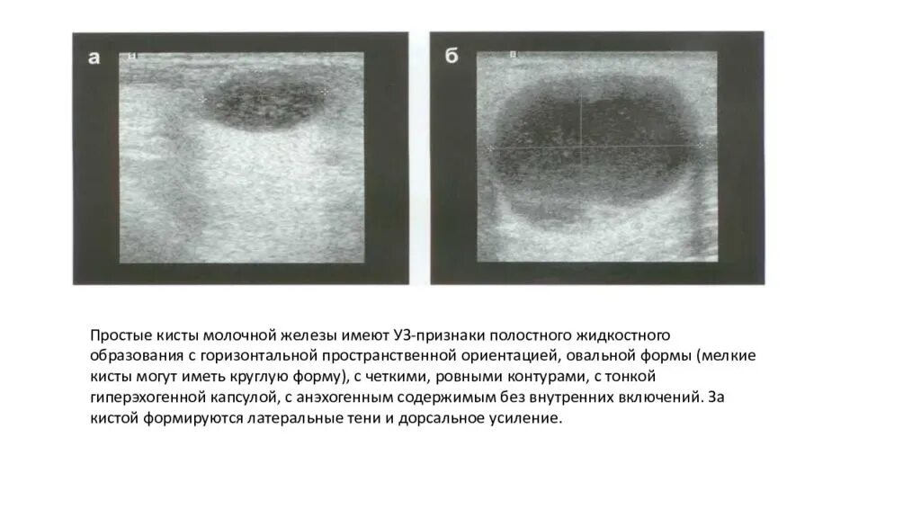 Образование молочной. Киста молочной железы на УЗИ описание. УЗИ признаки доброкачественных опухолей молочных желез. Атипичная киста молочной железы УЗИ.