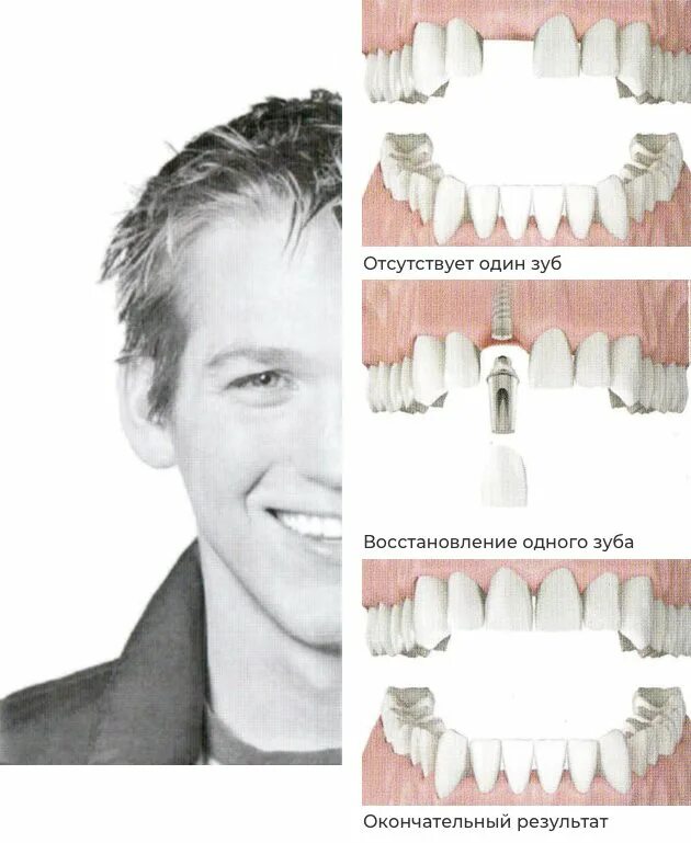 Через сколько можно вставить зубы. Восстановление зубов зубов импланты.