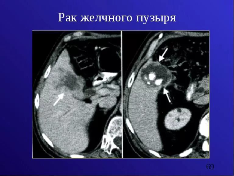 Отек желчного пузыря. Карцинома желчного пузыря кт. Аденокарцинома желчного пузыря на кт. Кт картина опухоли желчного пузыря. Опухоль общего желчного протока кт.