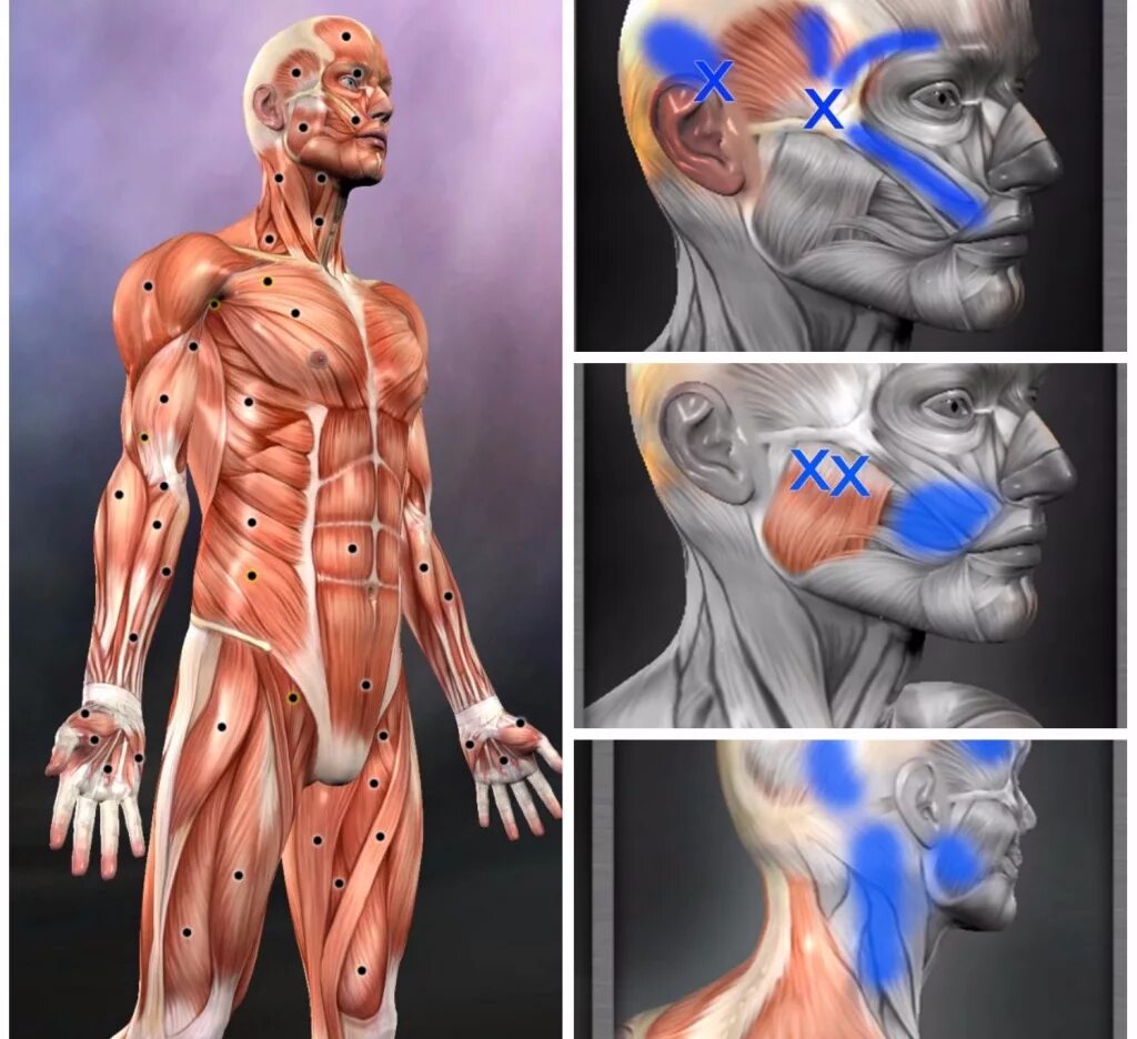Миофасциальные дисфункции. Триггерная точка миофасциальный болевой. Миофасциальный синдром триггерные точки. Миофасциальный болевой синдром триггерные точки. Миофасциальный массаж триггерных точек.