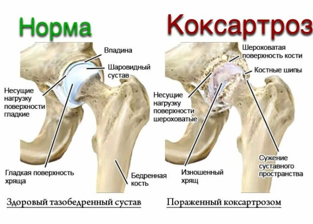 Какие болезни тазобедренного сустава. Стерт хрящ тазобедренного сустава. степени коксартроза тазобедренного сустава. артроз тазобедренного сустава симптомы. разрушение тазобедренного сустава 3 степени.