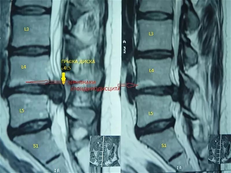 Радикулопатия справа. Радикулопатия l4-s1. Радикулопатия л4-s1. L4-s1 радикулопатия справа.