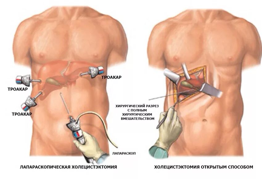 Удаление желчного пузыря отзывы врачей. Лапароскопия аппендицита шрамы. Операция лапароскопическая холецистэктомия. Лапароскопическая спленэктомия. Холецистэктомия желчного пузыря лапароскопическая.