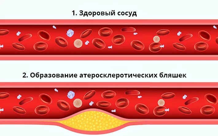 Давление при атеросклерозе сосудов