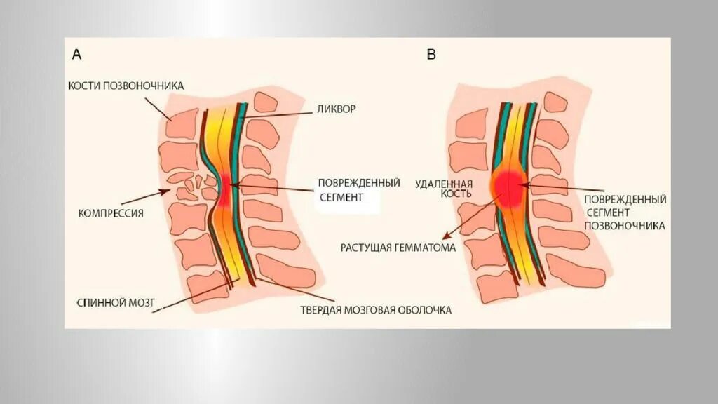 Компрессия шейного отдела позвонка. Защемление корешка спинного мозга. Сдавление Корешков спинного мозга симптомы. Механическое повреждение спинного мозга.