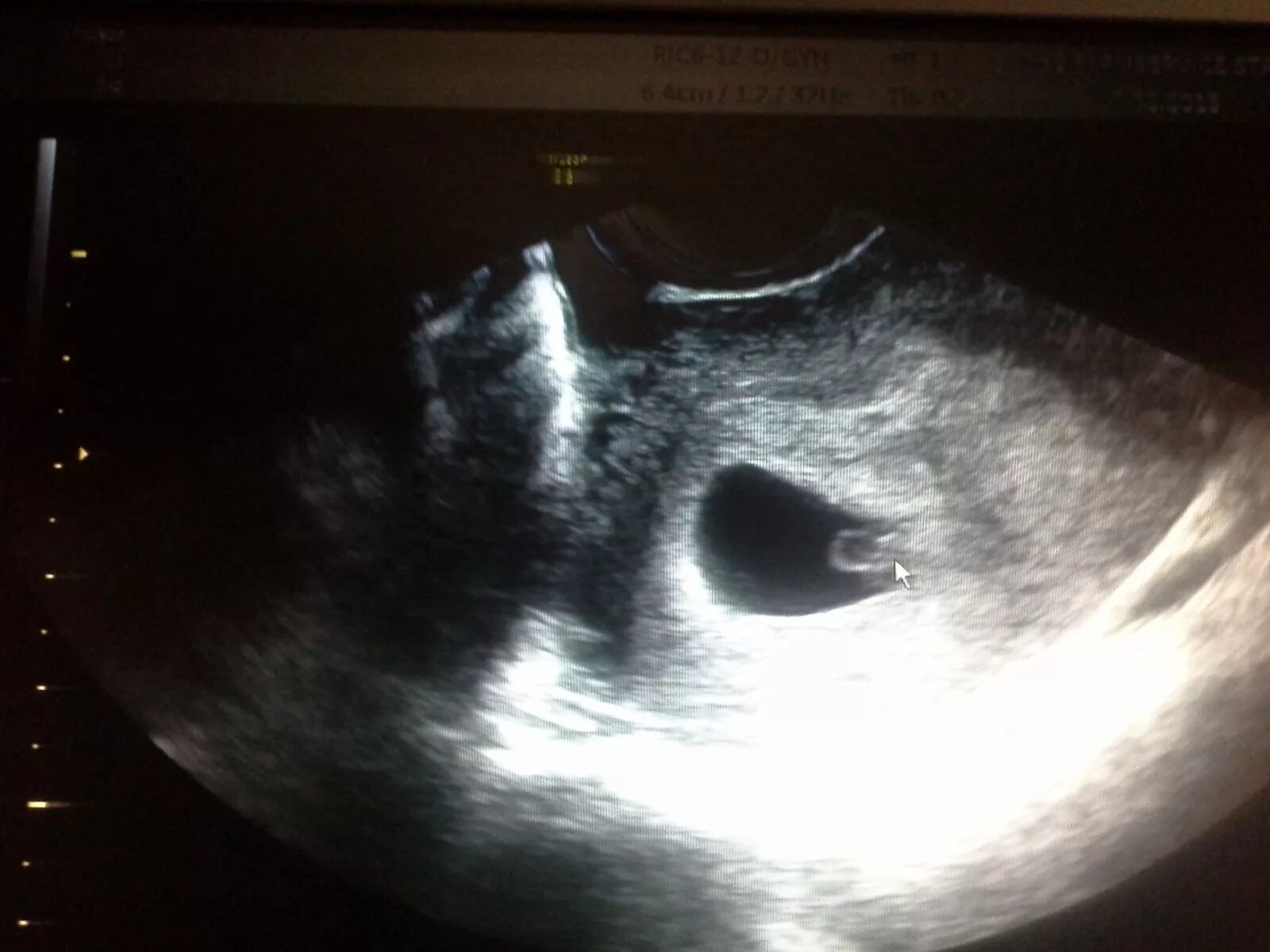 Плодное яйцо 3 мм. Плодное яйцо 8 мм желточный мешок 16 мм. плодное яйцо 16мм,эмбрион 6мм. плодное яйцо 19 мм желточный мешочек 3 мм. плодное яйцо 7 мм желточный мешок 1.3 мм.