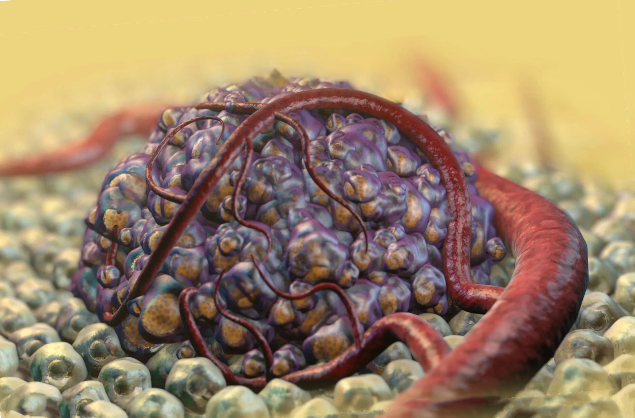 Злокачественная опухоль. Злокачественная опухоль. Злокачественное новообразование легкого. Нейрофиброматоз головного мозга. Как выглядит болезнь рак.