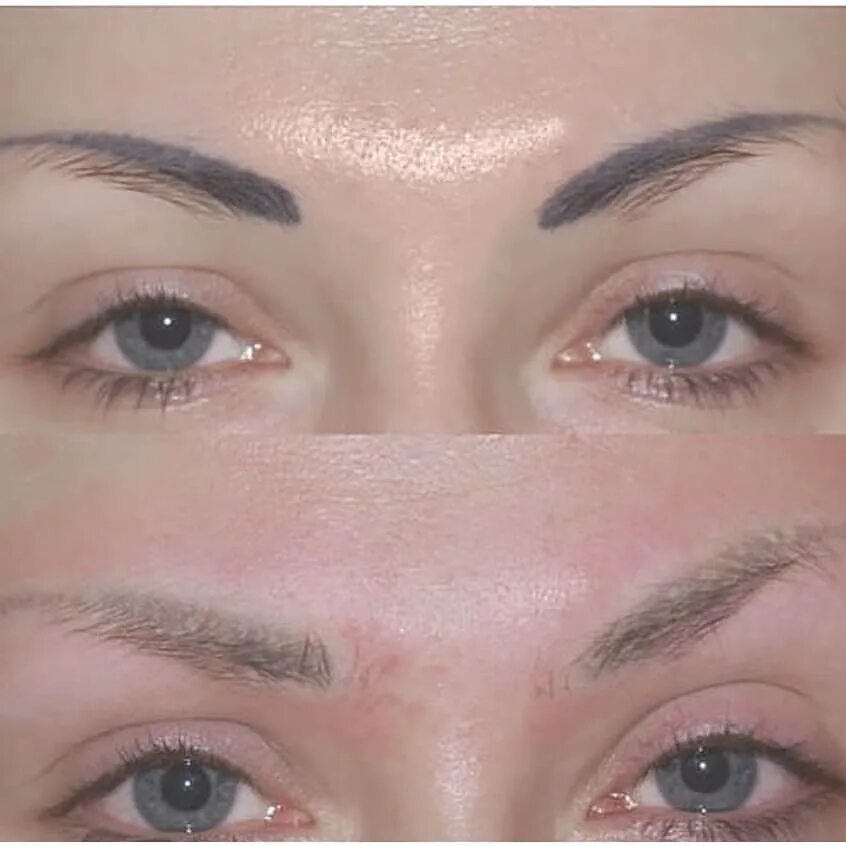 ремувер для бровей. ремувер для бровей. ремувер для снятия татуажа бровей. зеленый цвет бровей после лазера. процесс заживления бровей после ремувера.