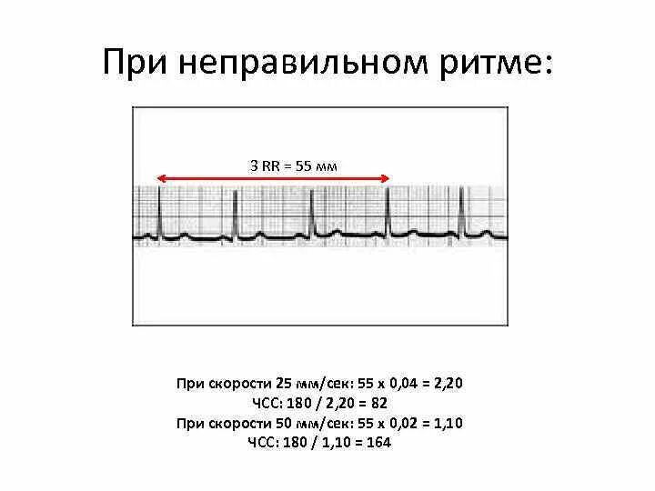 Как измерить частоту сердечных. Подсчет ЧСС на ЭКГ 50 мм/с. Формула ЧСС по ЭКГ 25 мм. Подсчет ЧСС на ЭКГ 25 мм/с. ЭКГ расчет ЧСС 50 мм.