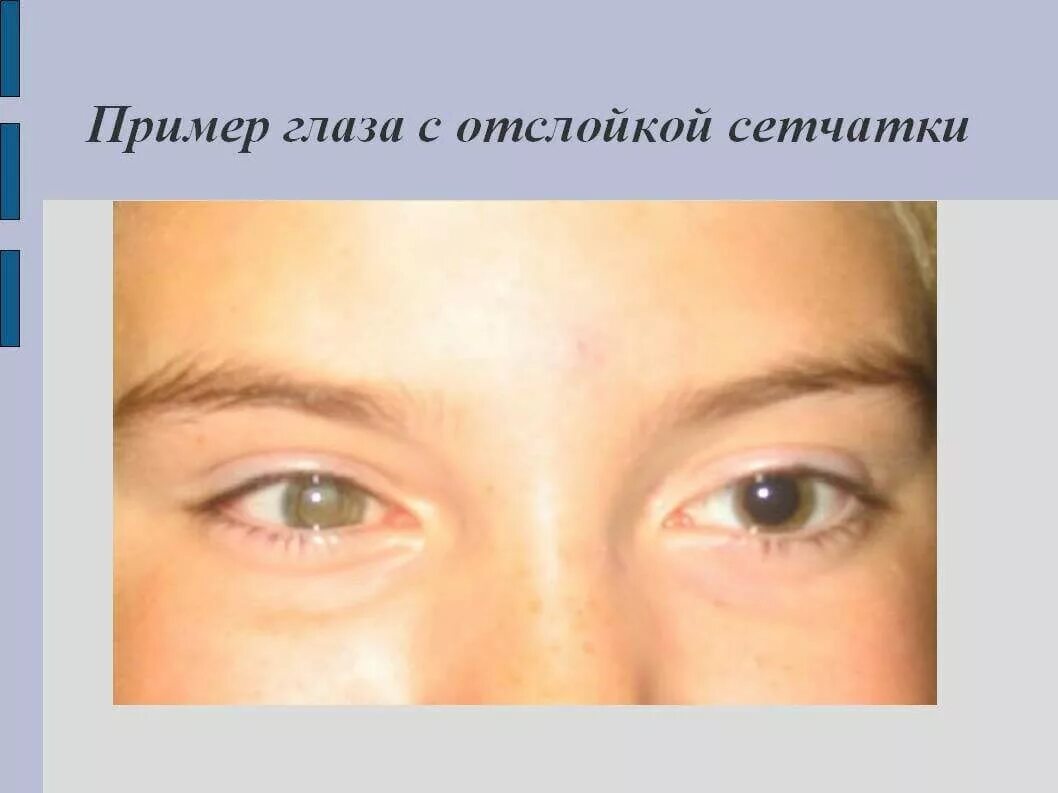 Отслойка сетчатки что делать