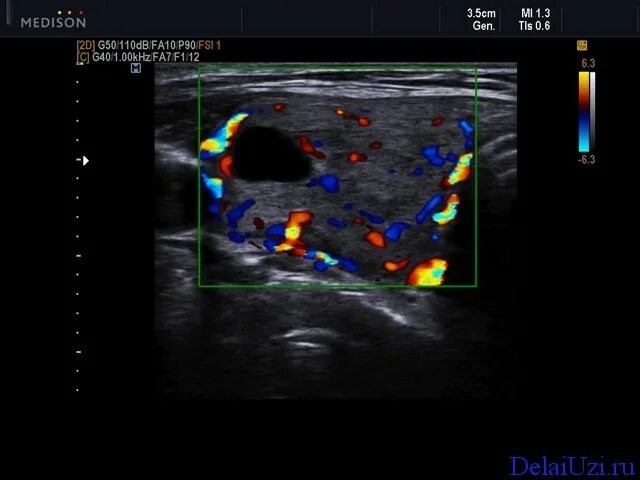 Перинодулярный кровоток узла щитовидной. Щитовидная железа цдк усилен. Щитовидная железа цдк усилен. Узи щитовидной железы и цветовое допплеровское картирование. Щитовидная железа цдк усилен.