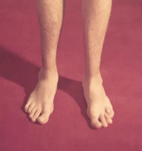Перепонки между пальцами у мужчин. Недоразвитые пальцы на ногах. Искривление пальцев ног. Нога человека.