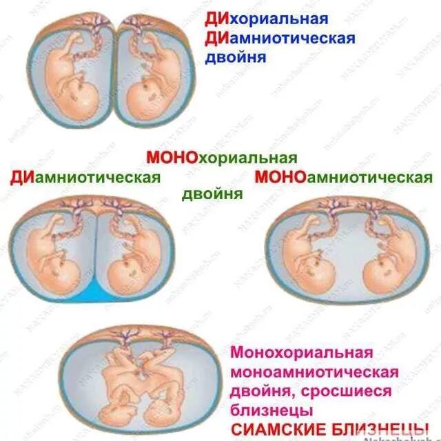 Отношения между близнецами и близнецами. Монохориальная бихориальная двойня. Монохориальная моноамниотическая многоплодная беременность. Монохориальная моноамниотическая двойня беременность. Многоплодная беременность дихориальная диамниотическая.