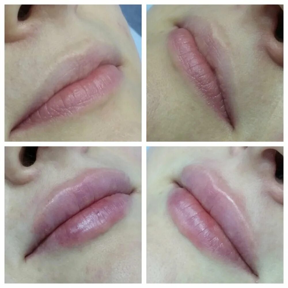 Губы накаченные гиалуроновой кислотой 1 мл. Зажившие губы 1мл гиалуронка. Увеличение губ заживления. Увеличение губ заживления. Губы 1 мл гиалуроновой зажившие.