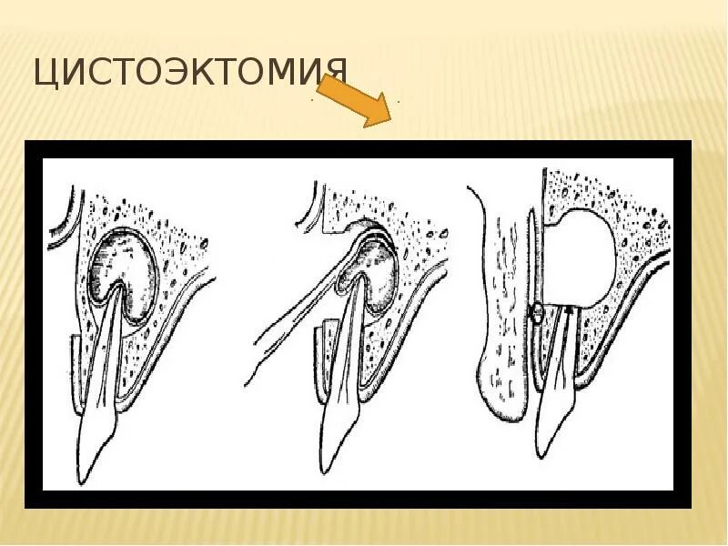 Цистоэктомия