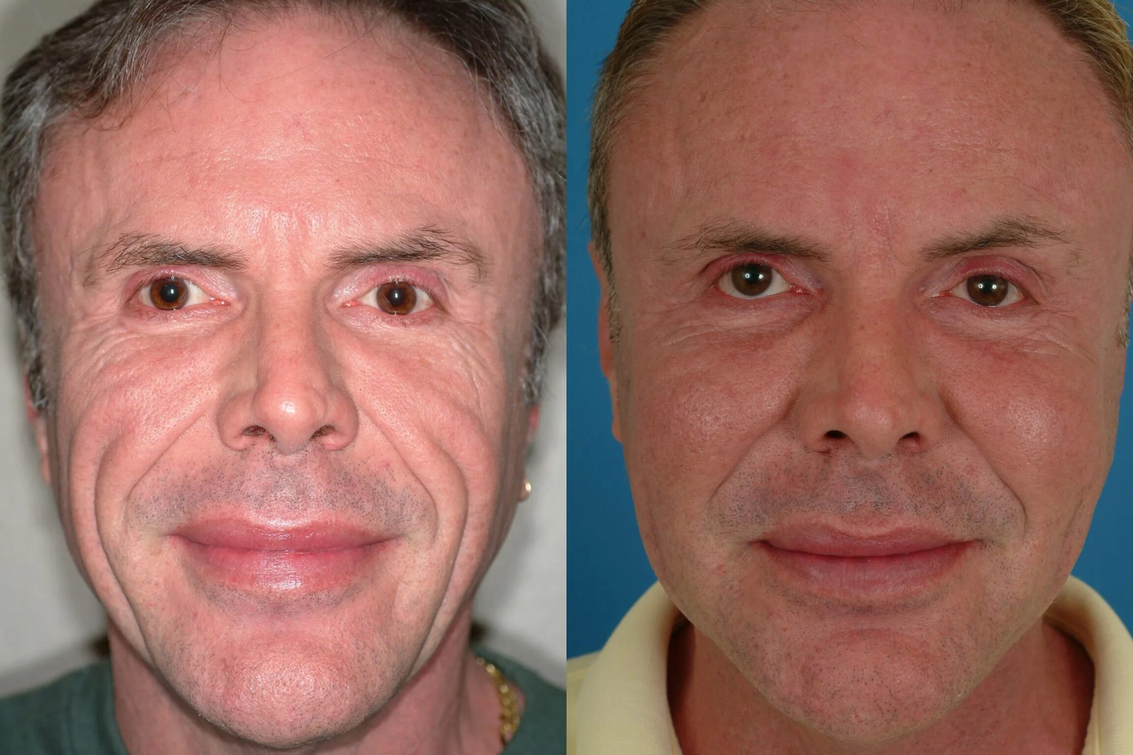 Мужчины после операции. Ластика лица у мужчин до и после. Пластика лица. Пластиковая хирургия лица. Пластика лица до и после мужчины.
