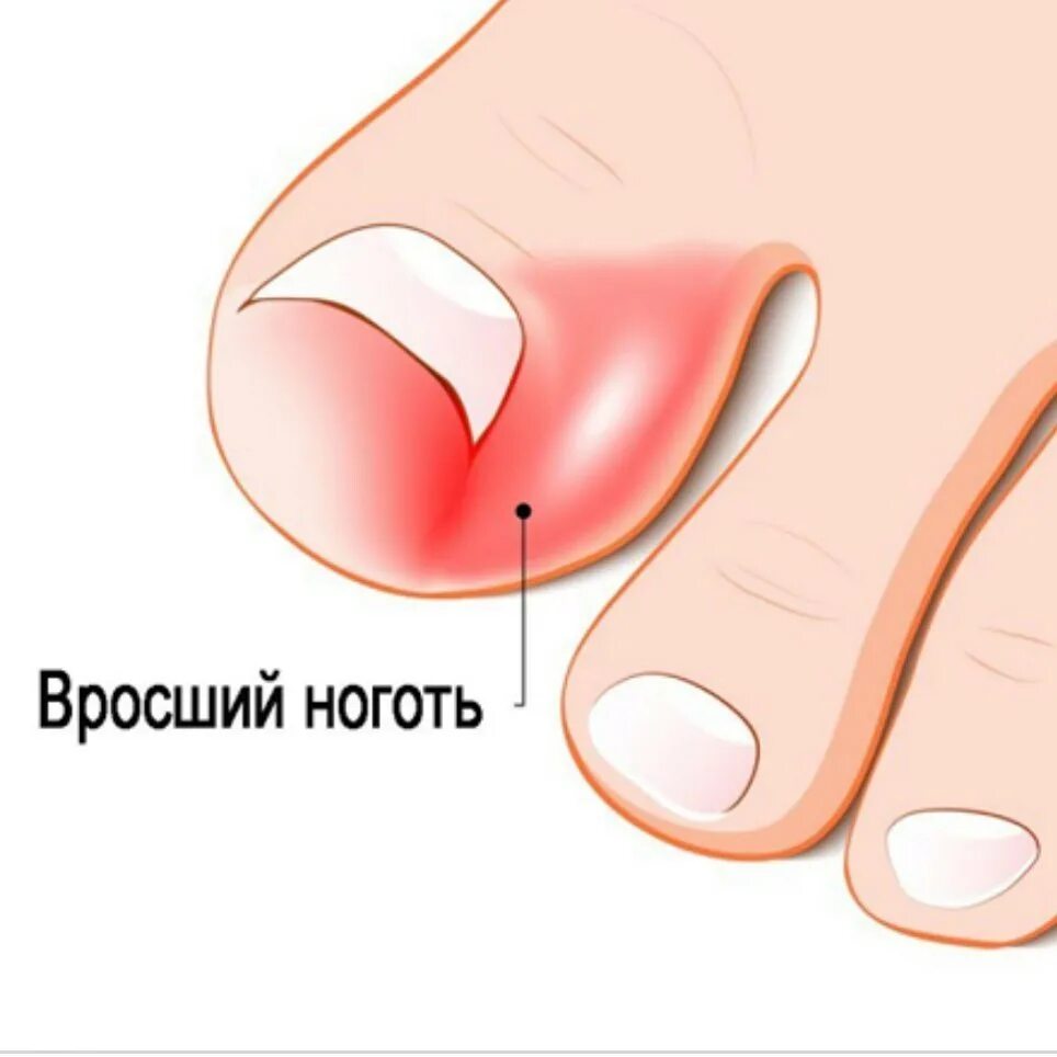 большие валики на ногтях на ногах