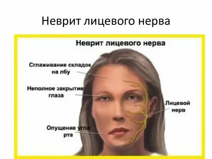 Перекошен рот причины