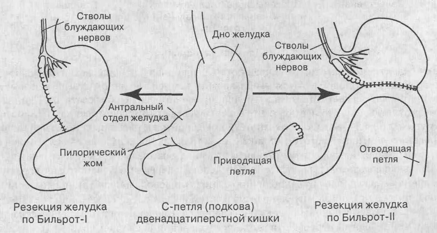 Последствия операции желудка. Резекция желудка по Бильрот 1 техника. Схема операции по Бильрот 1. Резекция желудка Бильрот 1 схема. Резекция желудка по Бильрот 2 схема.