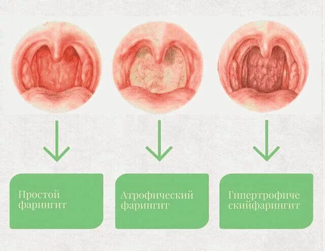 Почему долго болит горло