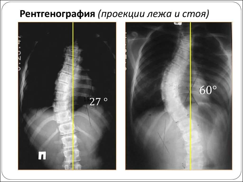 Рентгенография позвоночника в 2 х проекциях. Сколиоз 2 степени рентген. Сколиоз позвоночника рентген степени. Сколиоз 2 степени снимок рентген. Сколиоз 5 степени рентген.