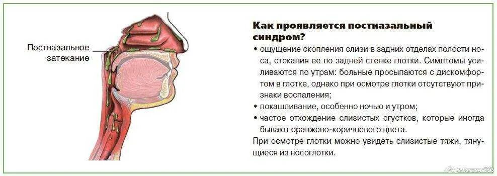 Ощущение тошноты в горле. Постринальный синдром. Постнанозалтный синдром.