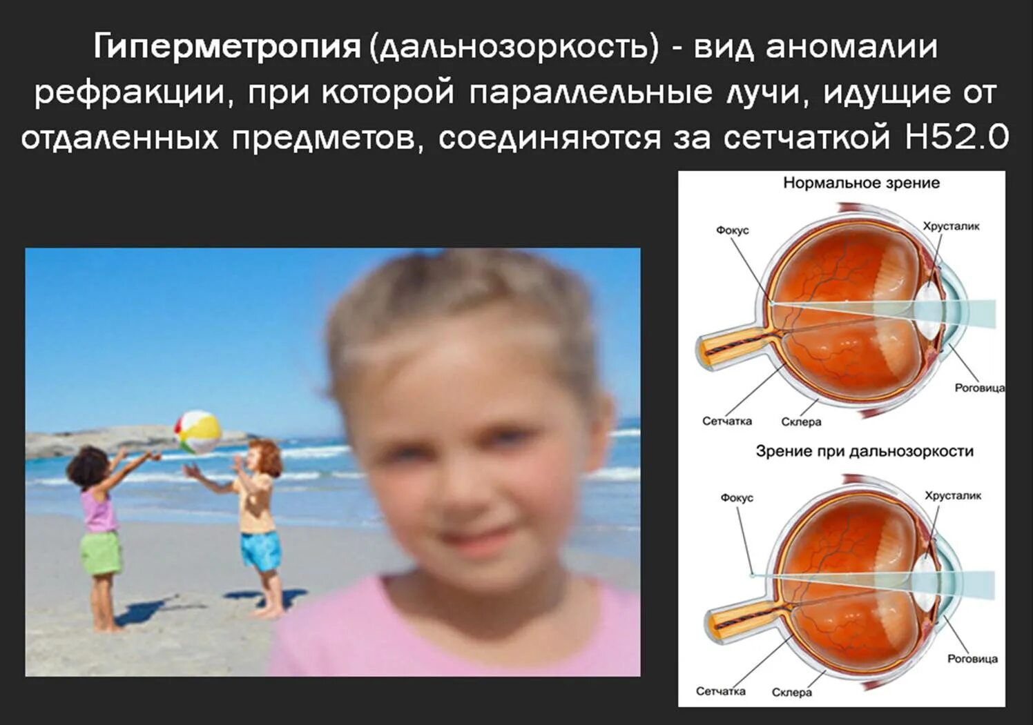 Гиперметропия слабой степени ou у детей. Глаз гиперметропия высокой степени. Дальнозоркость слабой степени. Осложнения гиперметропии. Миша страдает близорукостью а его брат дальнозоркостью