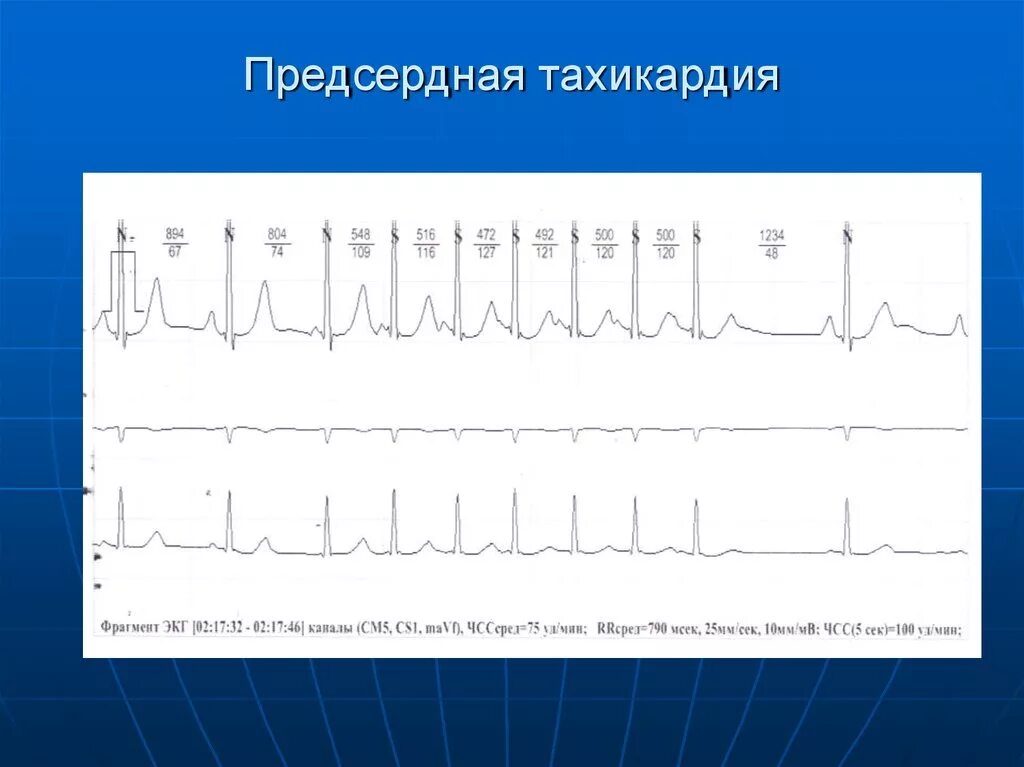 Суправентрикулярная экстрасистолия на экг. Непрерывно возвратная предсердная тахикардия. Фокусная эктопическая предсердная тахикардия экг. Фокусная предсердная тахикардия. Экг при предсердной тахикардии.