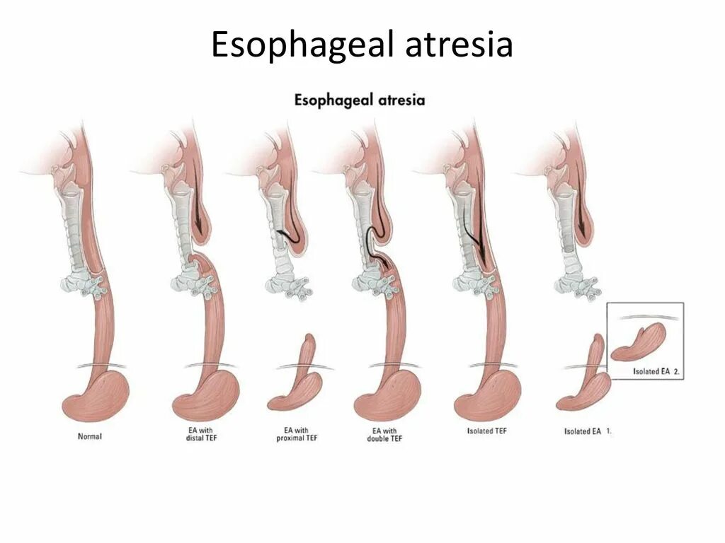 Отсутствие пищевода. Атрезия пищевода классификация gross. Атрезия пищевода этиопатогенез. Атрезия пищевода у новорожденных классификация. Врожденная атрезия пищевода.