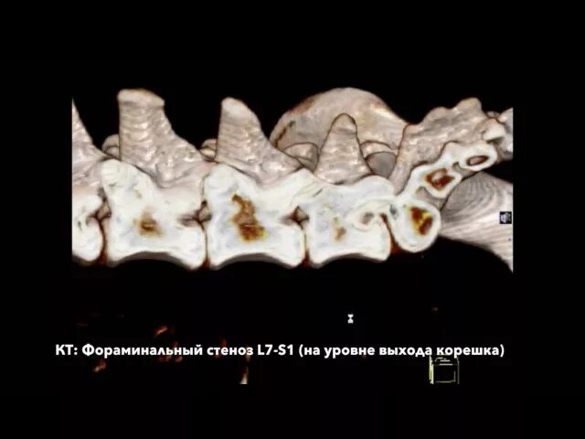 Крестцовый стеноз. Дегенеративный фораминальный стеноз. Фораминальный стеноз поясничного. Фораминальный стеноз степени. Фораминальный стеноз поясничного отдела позвоночника 1 степени.