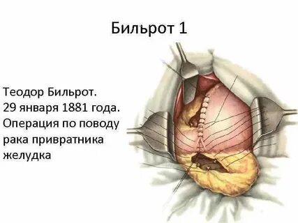 Операция привратника желудка