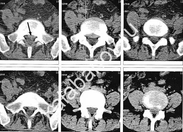 Медианно парамедианная билатеральная. Фораминальная грыжа диска кт. Парамедианная грыжа. Дорсальная парамедианная грыжа. Задняя парамедианная грыжа.