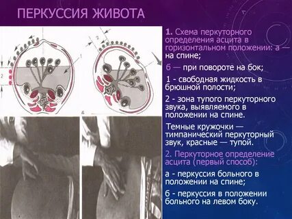 Перкуссия живота