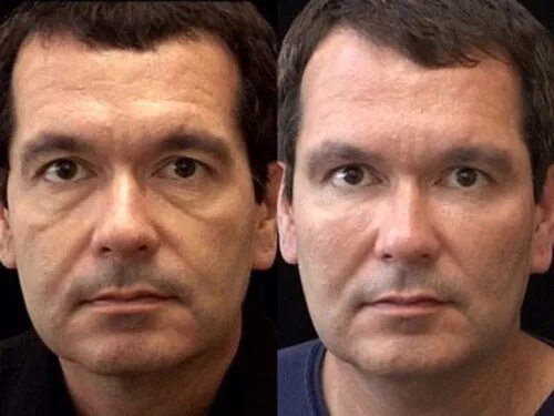 Salon Esthétique Natural face lift, Facial exercises, Face lift exercises