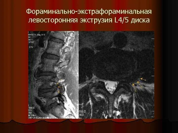 Медианно парамедианная протрузия диска. Медианно парамедианная протрузия диска